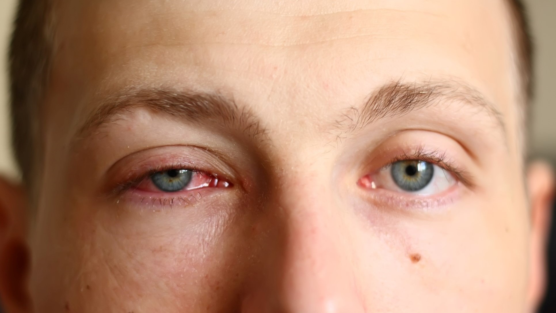 A Primer on Pink Eye
